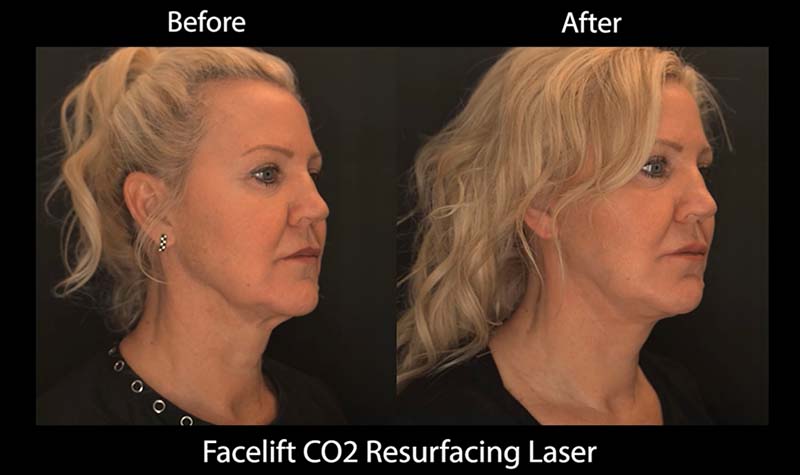 Before and after Facelift CO2 Surfacing Laser