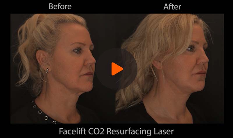 Before and after video showing Facelift CO2 Surfacing Laser