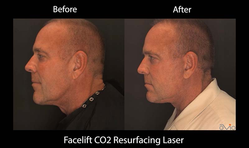 Before and after Facelift CO2 Surfacing Laser