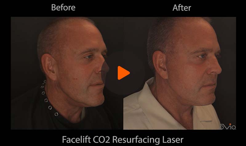 Before and after video showing Facelift CO2 Surfacing Laser