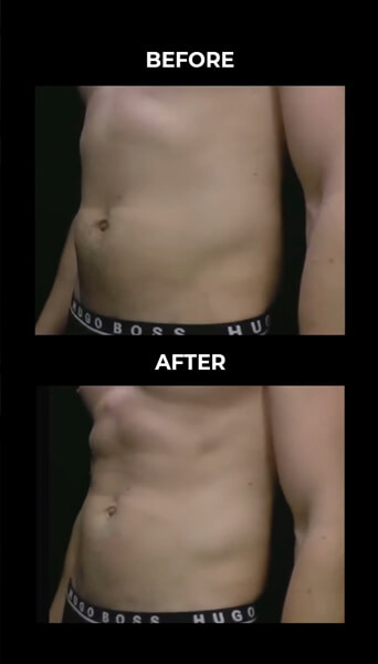 Before and after photos of the oVio 360 device showing waist slimming.